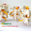 VERTEBRA12 (12396) Medical Science Life-size Lumbar Vertebrae Models in 3 Stages of Degeneration